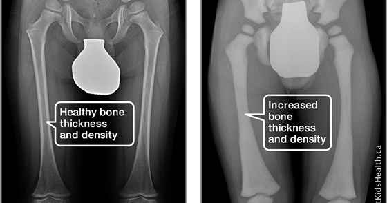 Normal and Osteopetrosis bones 