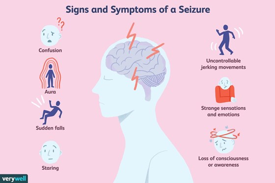 seizures as a symptom of multiple sclerosis 2440813 2cafbb9630cd4c65bfa0a9bd08c3fb2f