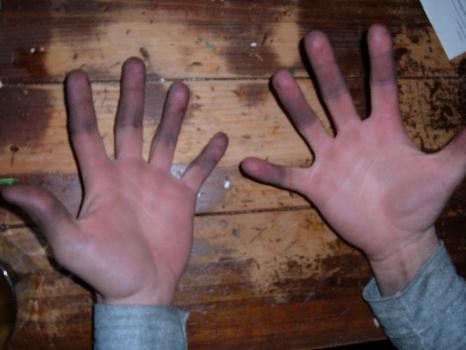 PSA-Don't weld with fingerless gloves