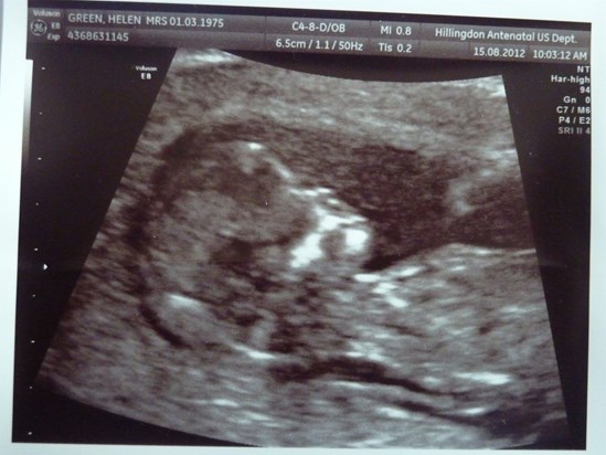 Bailey's 12 week scan 15th August 2012 91 month before he was born)