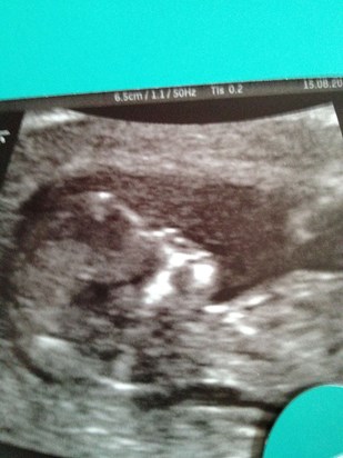 12 week scan August 15th - where it all started to go wrong xx