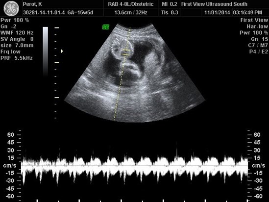 Our 3D ultrasound visit