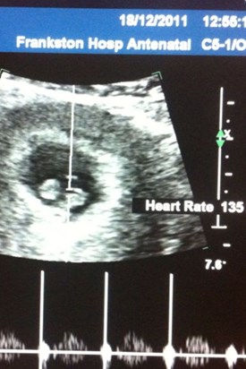 lilys 8 weeks scan