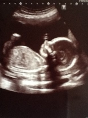 Denzel's 20 wk scan he wouldn't stop wriggling!!!!