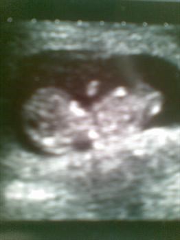 Leon's first scan picture at around 10 weeks xx 