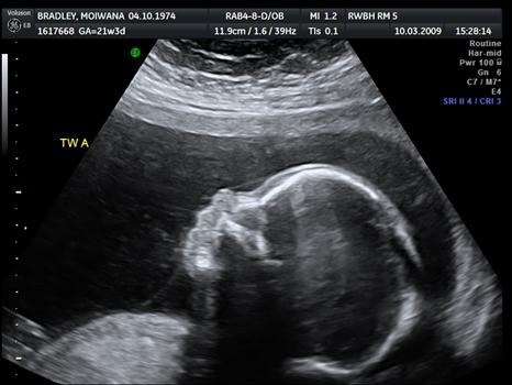 Twin A, 21 weeks