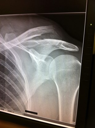 Shoulder X ray