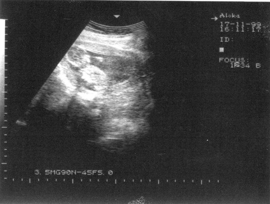 Ultrasound - 13 weeks & 3 days pregnant