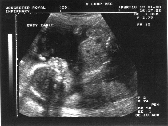 Ultrasound - 21 weeks & 5 days pregnant