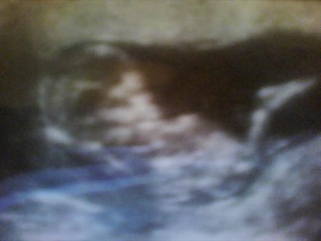 new baby 1st scan