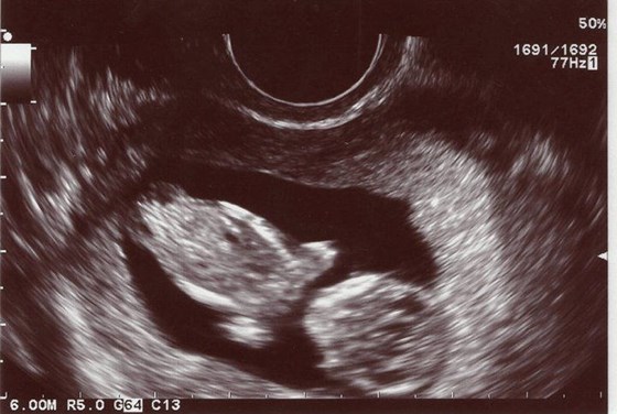 Our First Scan... 11 Weeks <3
