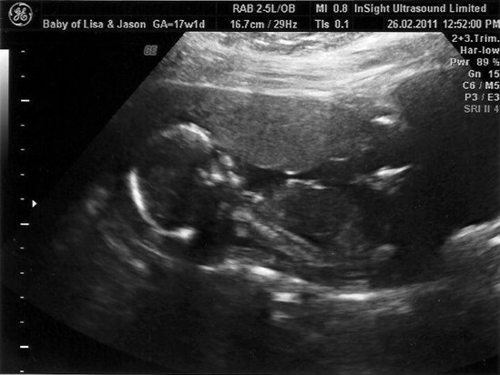 Our Private Scan At 17 Weeks & 1 Day <3