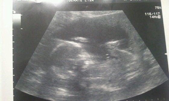 Congratulations It's A Girl <3 21 Weeks & 6 Days