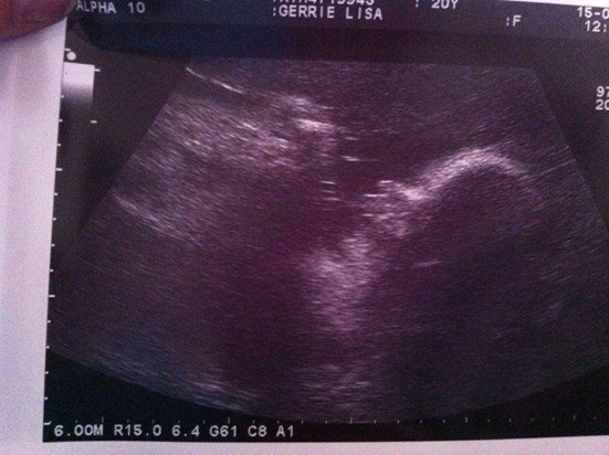 Our Scan At 32 Weeks & 2 Days. Princess Hiding Her Face 