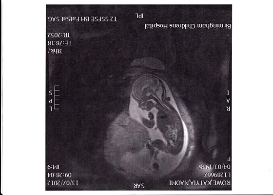 Lucian's MRI Scan 23 Wks