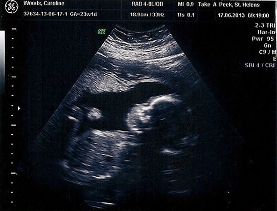 Lily's scan x