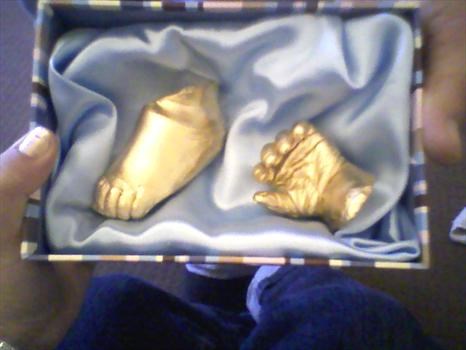 Devon's hand n foot cast