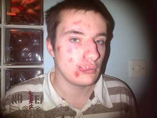 this is how David used to look after a bad seizure. He hated going out looking like this! :(