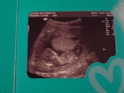 Our Wee Elle's 12wk Scan Photo