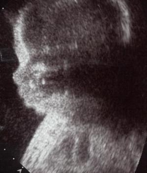 Emma Ultrasound