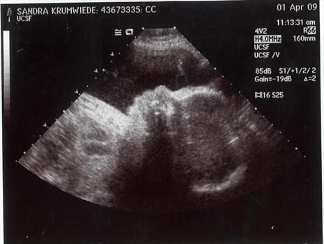 Emma Ultrasound Full