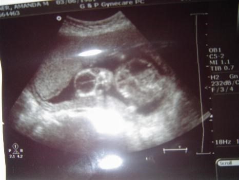 Ultrasound - 20 weeks