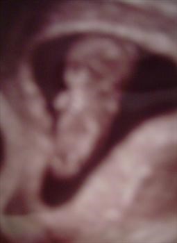 Ultrasound - 11 weeks