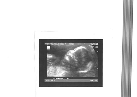 Megan at 20 week scan when she scared mummy with her big Carville head measurements (2)