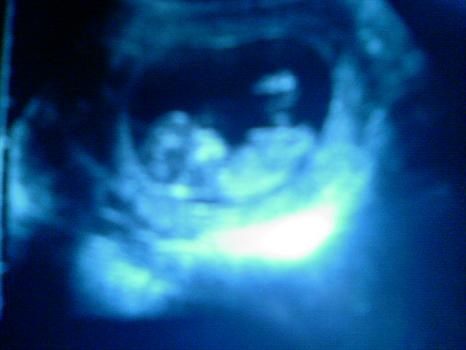 First scan, at 12 weeks