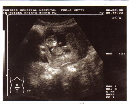 Kassidy   12 week ultrasound picture