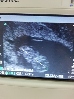 1st Ultrasound!